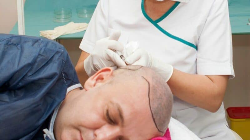hair transplants