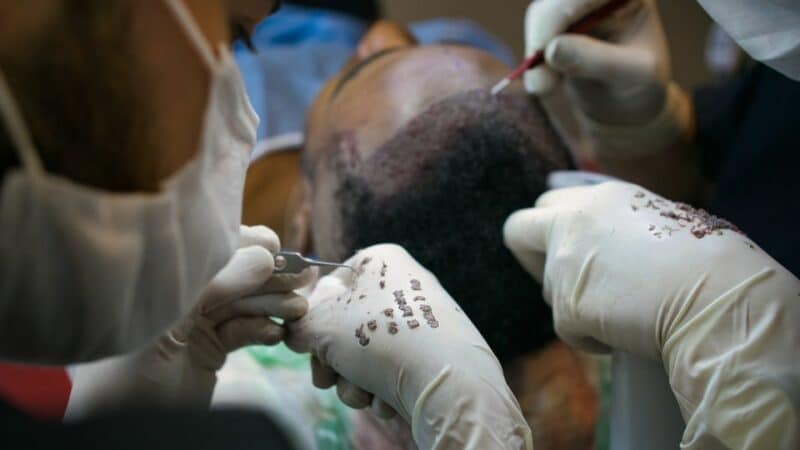 hair transplants