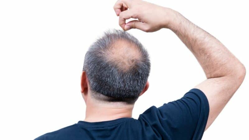 עצירת התקרחות