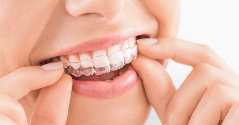 יישור שיניים: מתי זה הכרחי ומהן האופציות הקיימות היום?