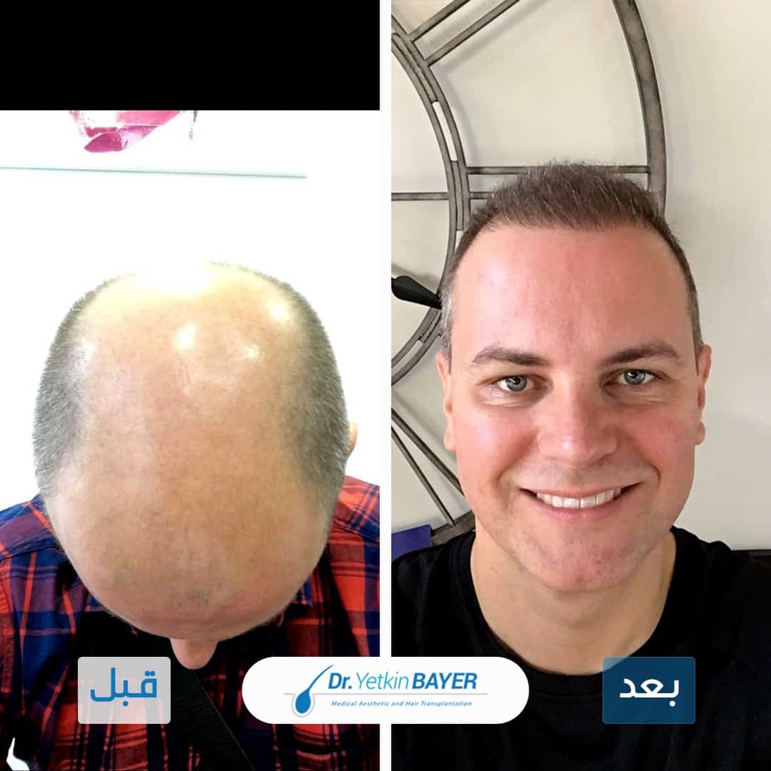 מה עדיף – השתלת שיער בשיטת DHI או FUE