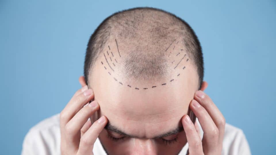 כמה זמן אחרי השתלת שיער אפשר להסתפר?