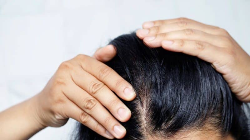 Hair Loss 1 e1664337237128 איבוד שיער