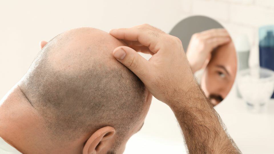 מה הם הקריטריונים להשתלת שיער?