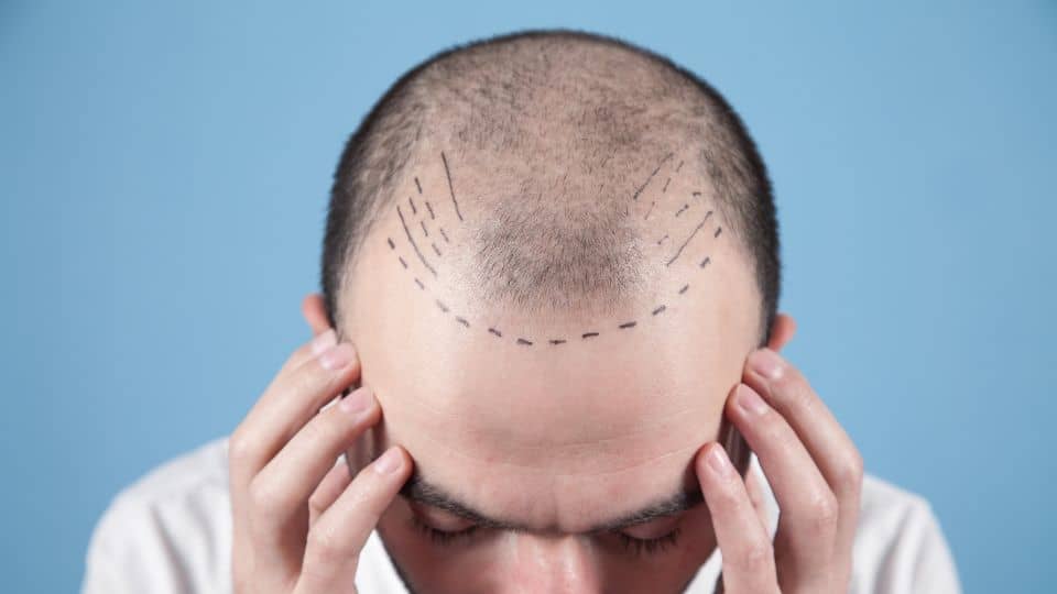 מה הם הקריטריונים להשתלת שיער?
